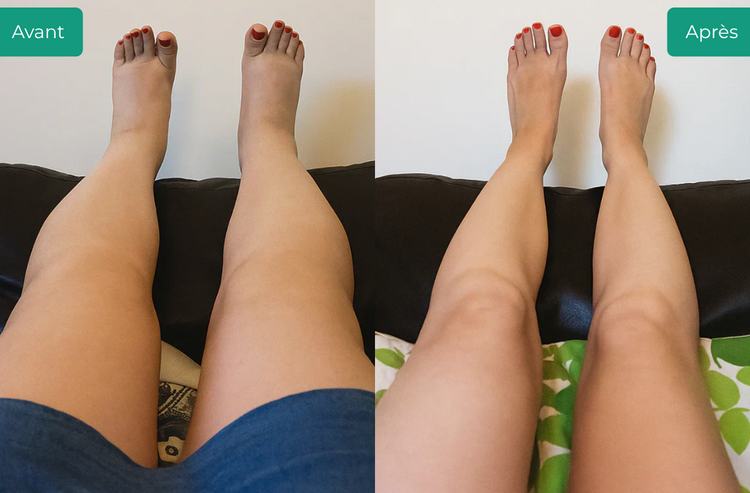 Water retention vs lymphatic drainage