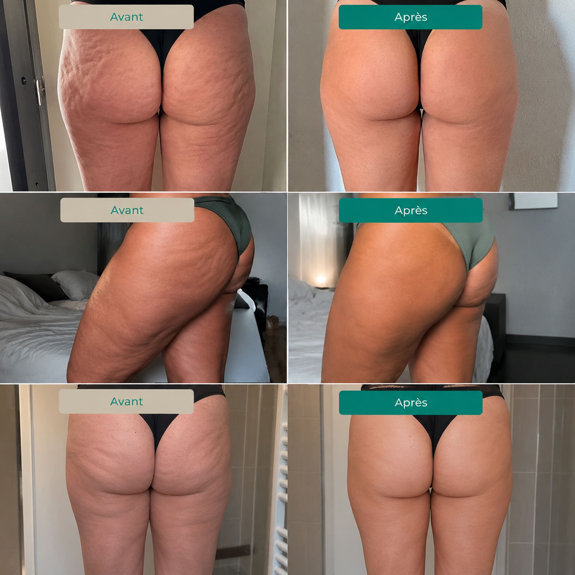 Lynae - Drainant Lymphatique - Cellulite